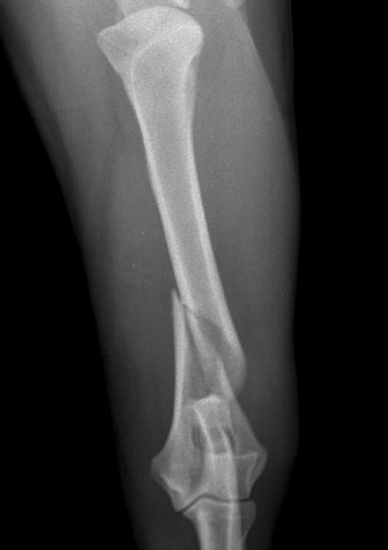 Bone Callus